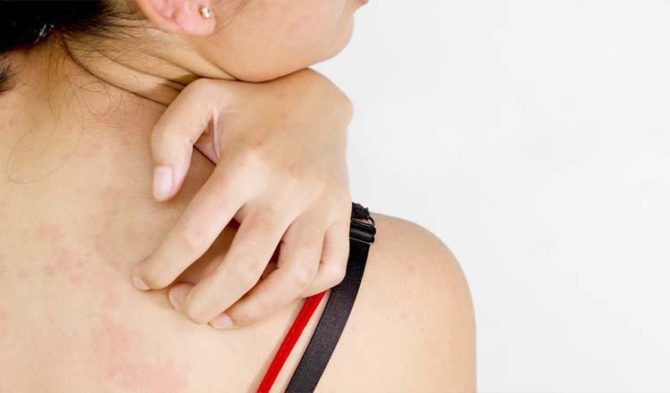 অস্বস্তিকর ঘামাচি দূর করার প্রাকৃতিক উপায়