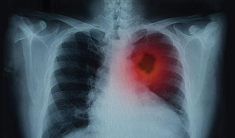 ফুসফুসের ক্যান্সারের প্রাথমিক লক্ষণ