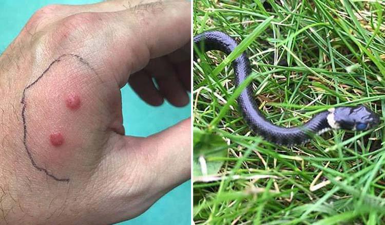 সাপে কাটলে যা করবেন, বাঁচবেন যেভাবে!